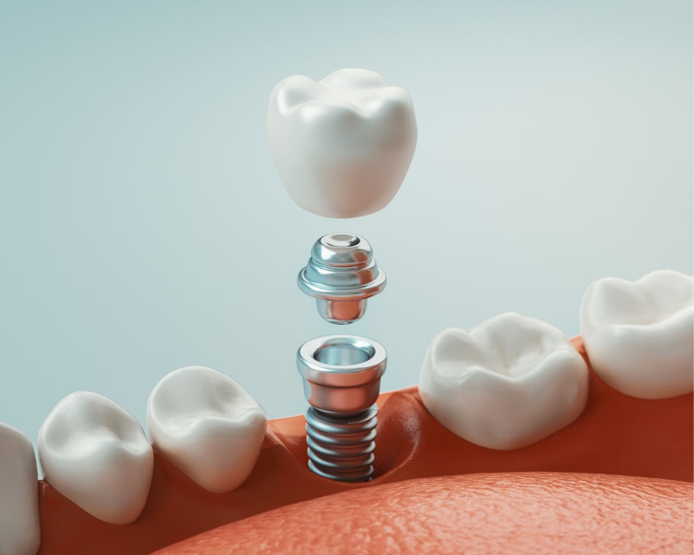 Implants dentaires, Dentiste à Québec